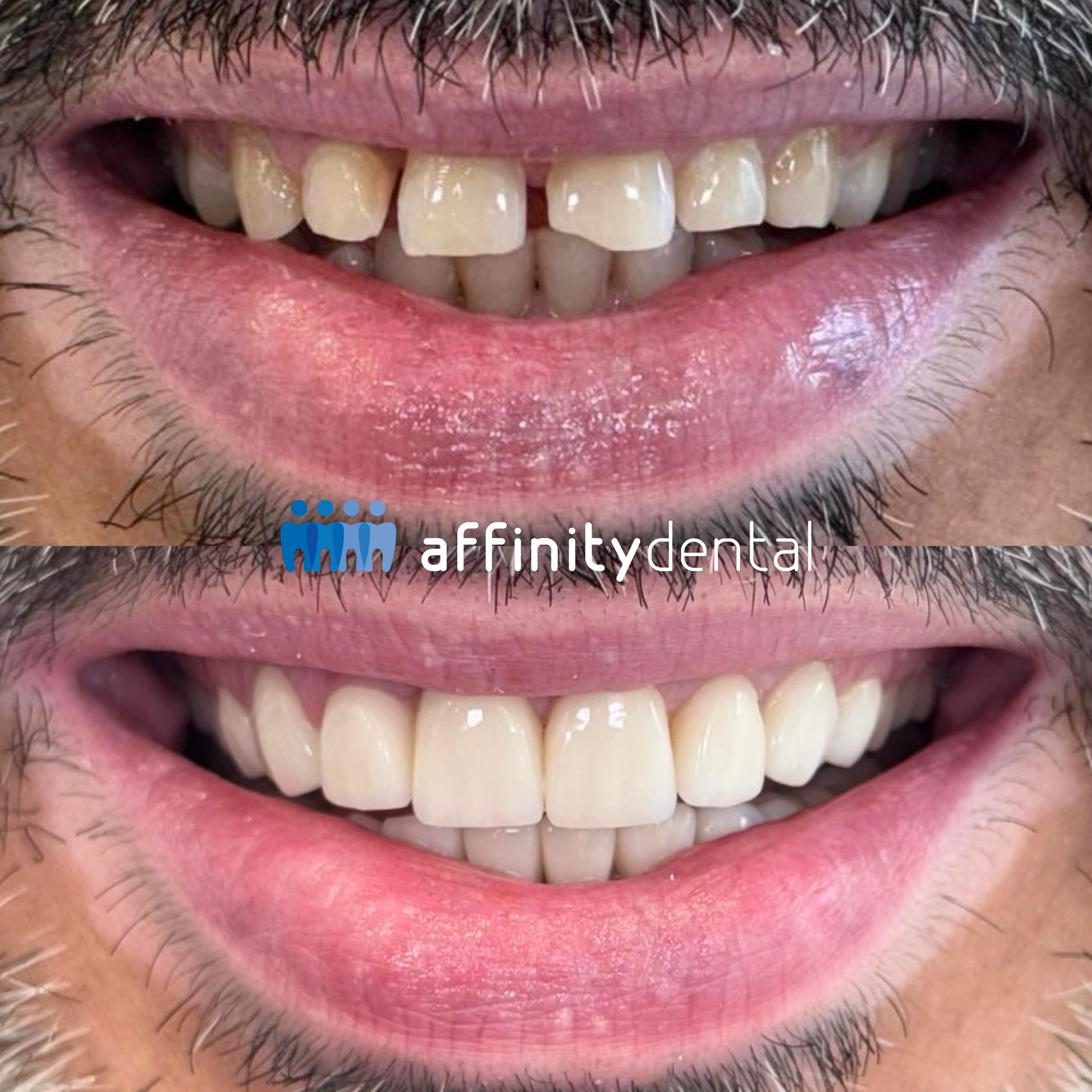 Before and after full-mouth zirconia crowns restoring smile and bite for a bruxer at Affinity Dental Clinics