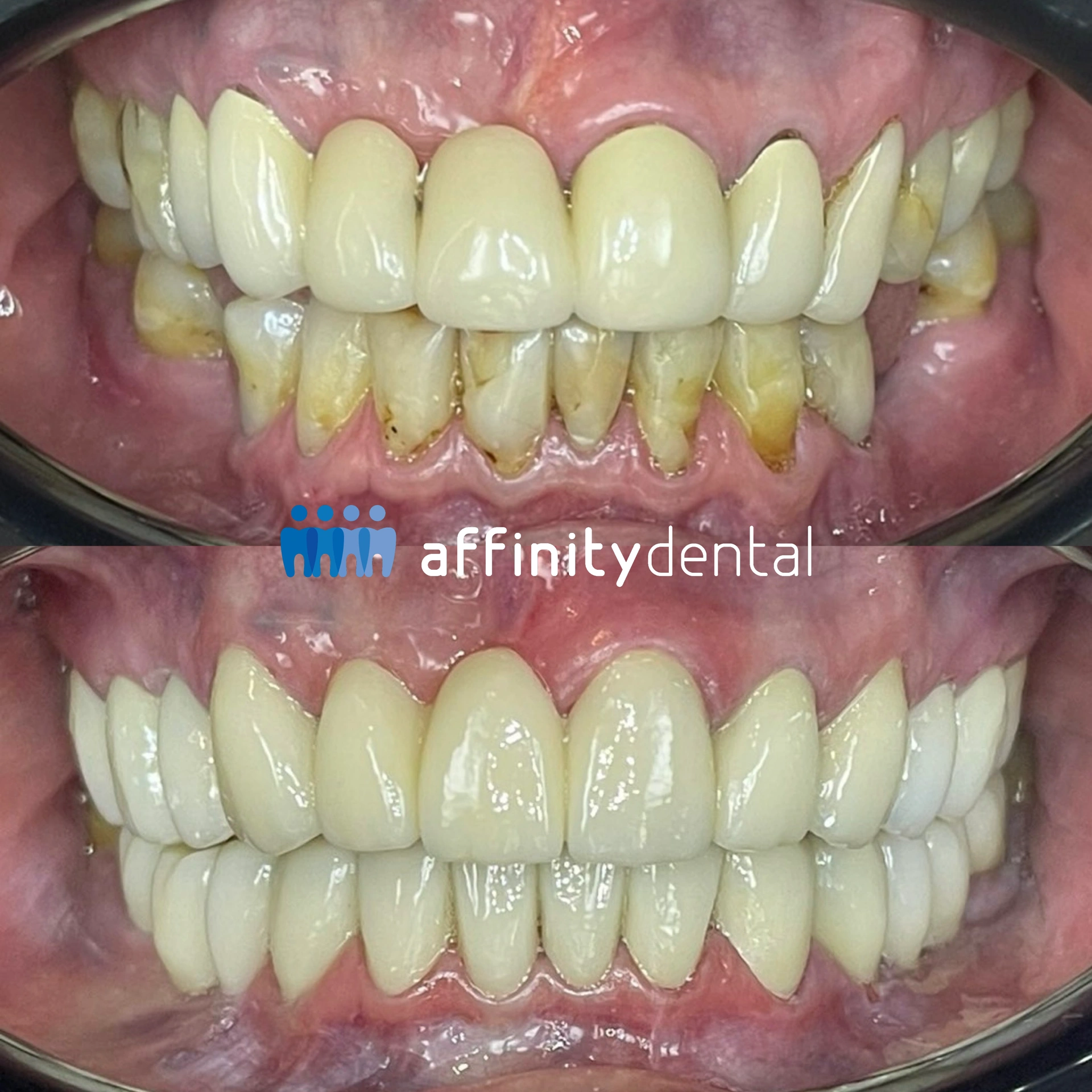 Before and after full-mouth smile makeover replacing old PFM bridges and crowns with zirconia restorations at Affinity Dental Clinics