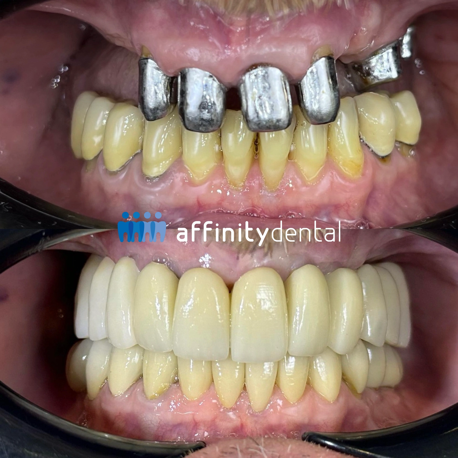 Before and after full-mouth smile makeover with implants, bone grafts, zirconia bridge, and zirconia crowns at Affinity Dental Clinics Makati