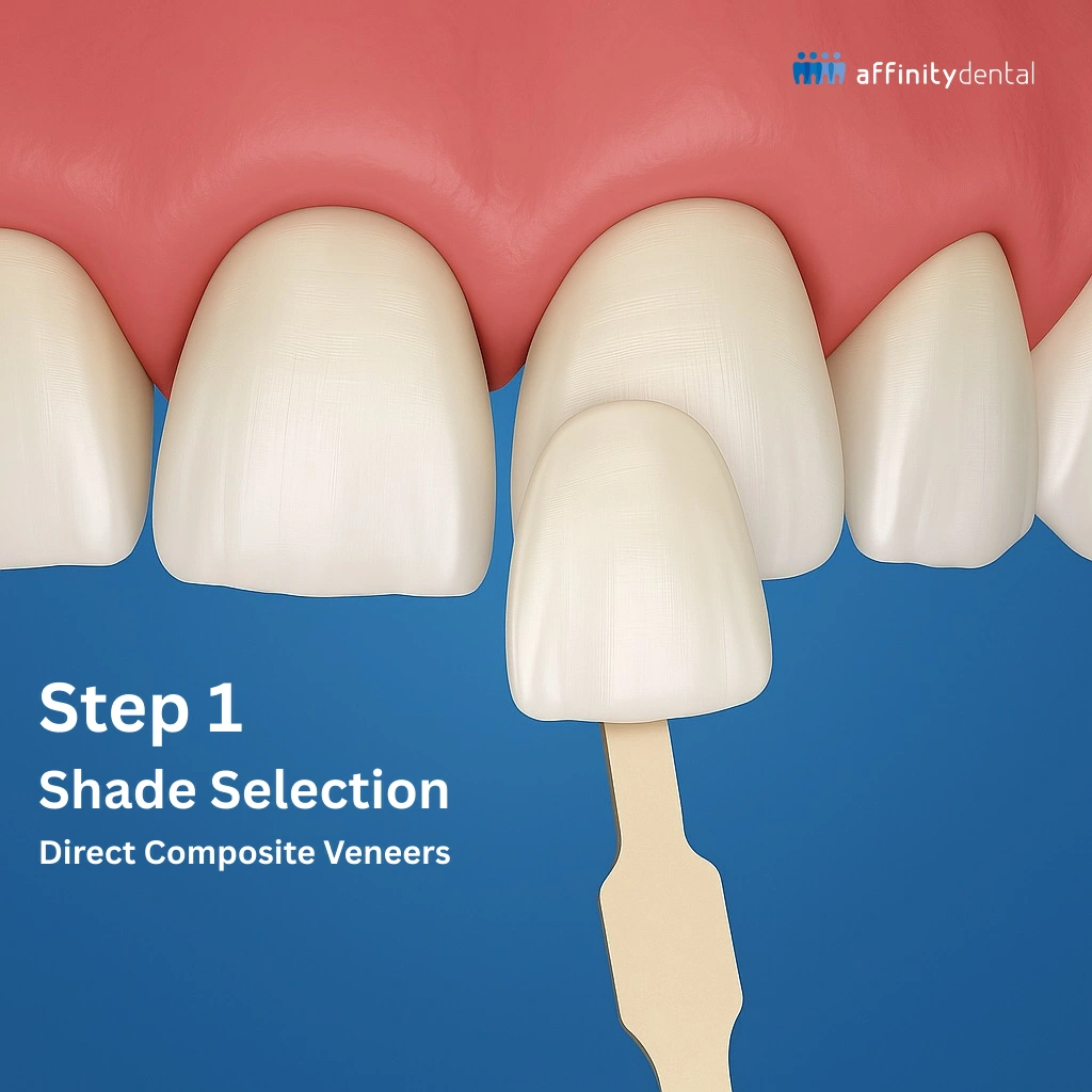 Dentist selecting composite resin shade with shade guide for direct composite veneers at Affinity Dental Clinics.