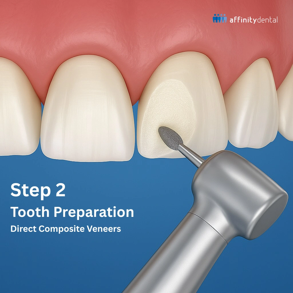 Minimal tooth preparation using a high-speed handpiece with diamond bur for direct composite veneers at Affinity Dental Clinics.