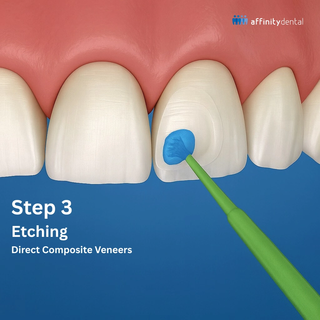 Application of etching gel with a micro brush during direct composite veneer procedure at Affinity Dental Clinics.