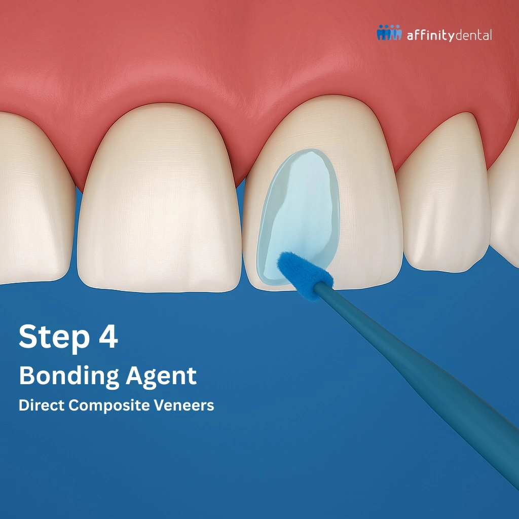 Micro brush applying bonding agent to prepared tooth for direct composite veneers at Affinity Dental Clinics.