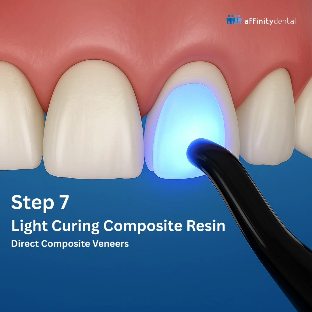 Light Curing Direct Composite Veneers – Affinity Dental Clinics