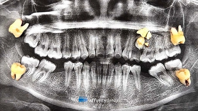 Panoramic X-ray showing removal of all four wisdom teeth and a supernumerary tooth at Affinity Dental Clinics Makati