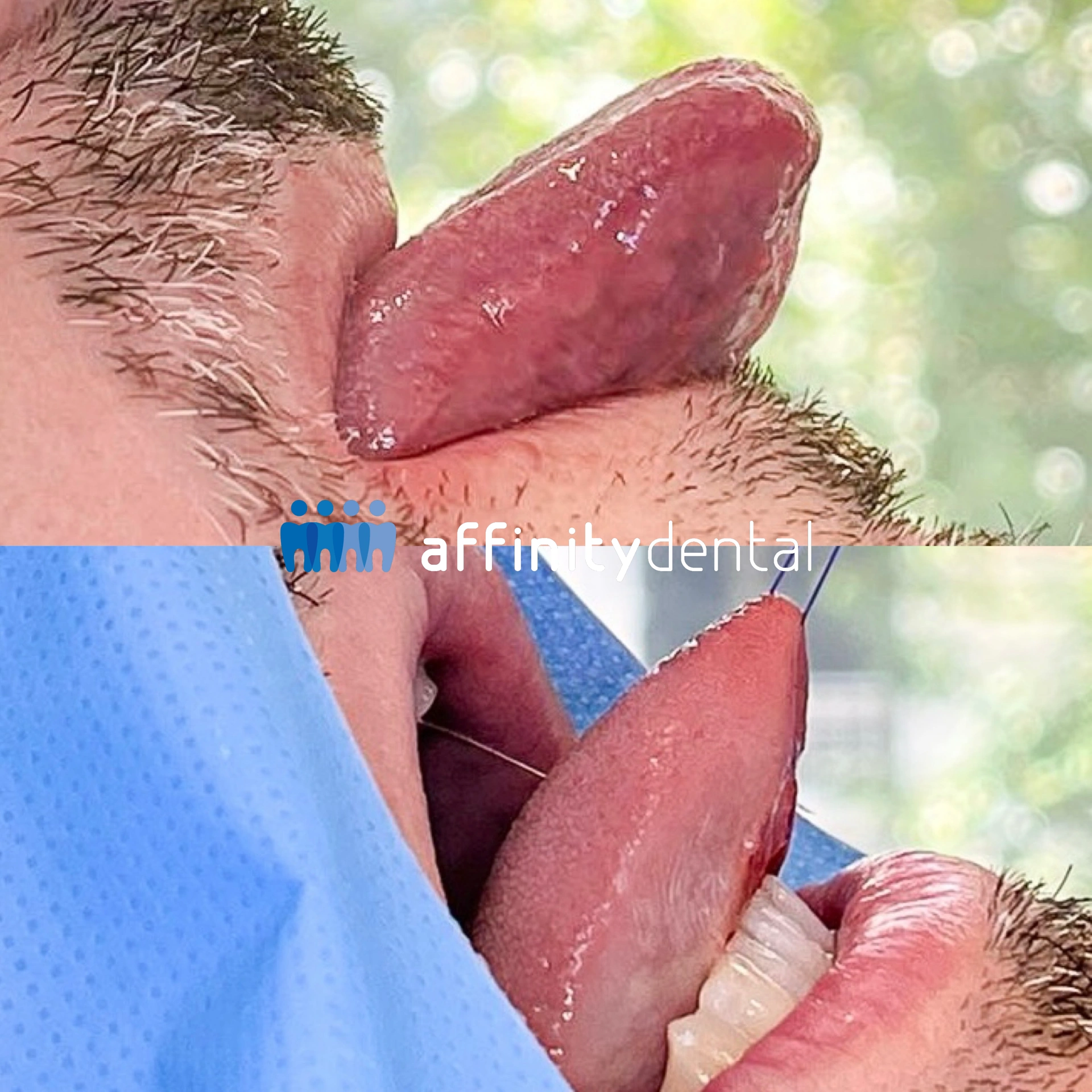 Before-and-after photos showing correction of tongue tie (ankyloglossia) through frenectomy surgery at Affinity Dental Clinics.