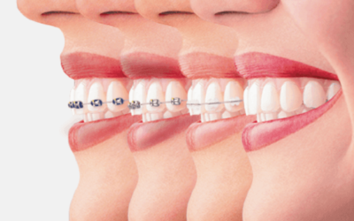 4 Types of Braces to Align Your Teeth