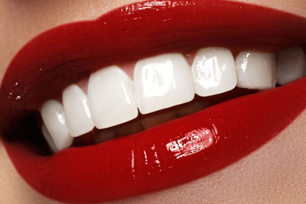 Whiten Veneers