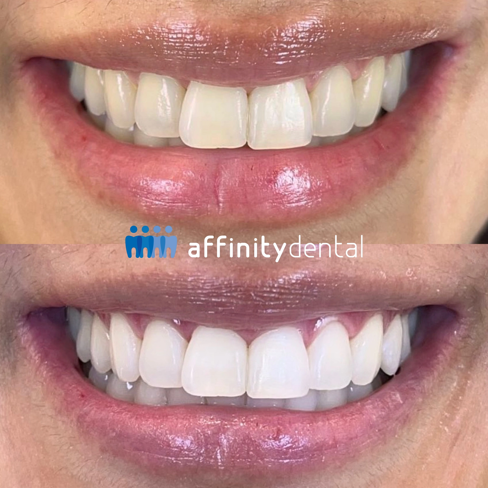 Before and after professional teeth whitening showing brighter smile at Affinity Dental Clinics