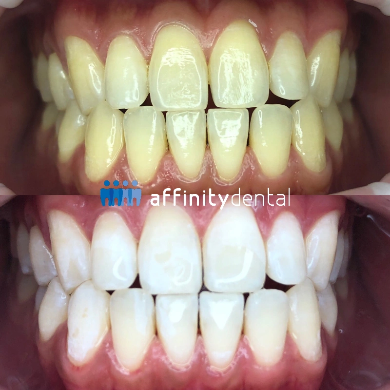 Before and after professional teeth whitening showing yellow teeth transformed into a brighter smile at Affinity Dental Clinics