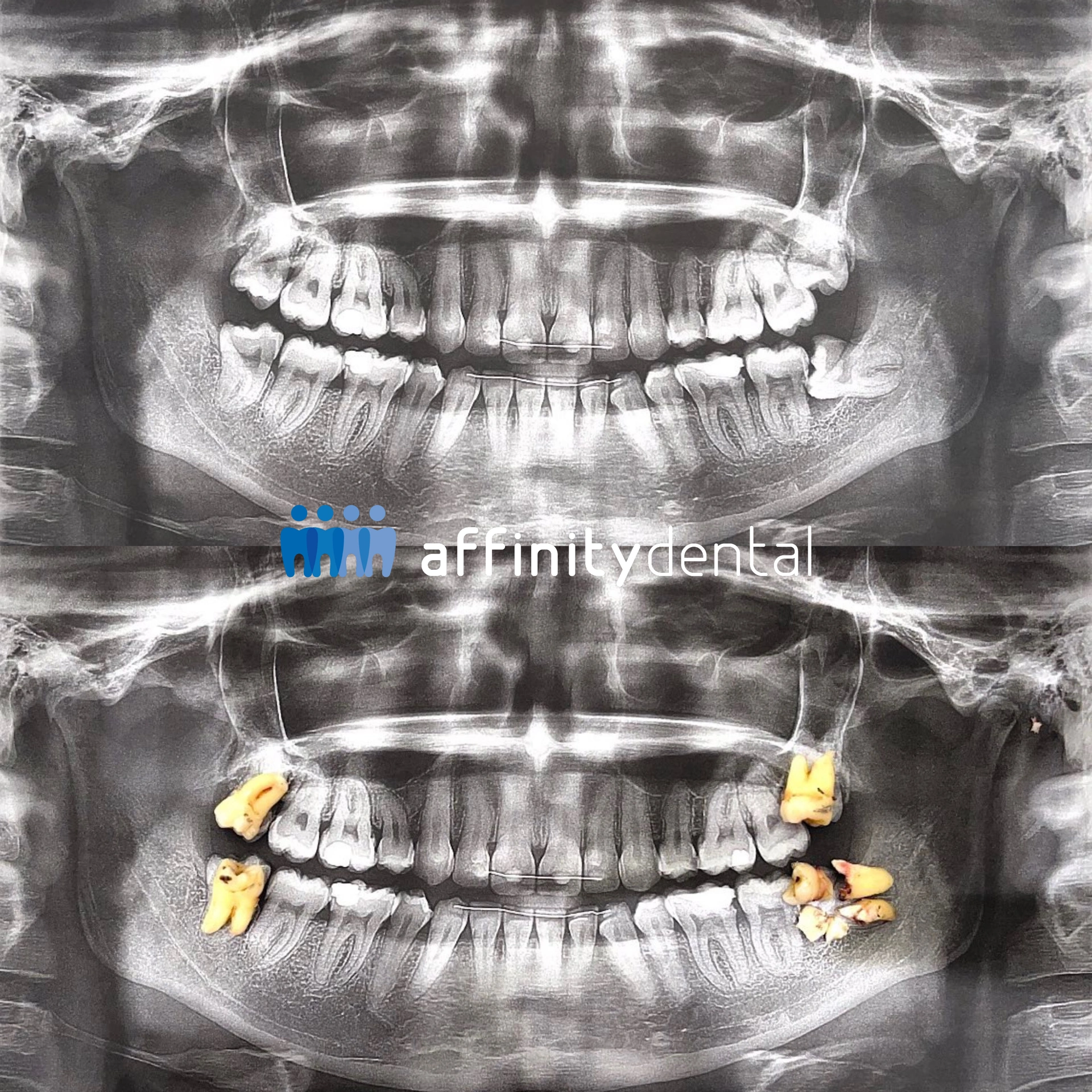 Panoramic X-ray showing before and after wisdom teeth extraction with removed teeth placed over the image at Affinity Dental Clinics BGC Stopover
