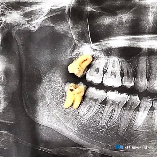 Panoramic X-ray with extracted wisdom teeth placed over the image after surgical removal at Affinity Dental Clinics Ortigas