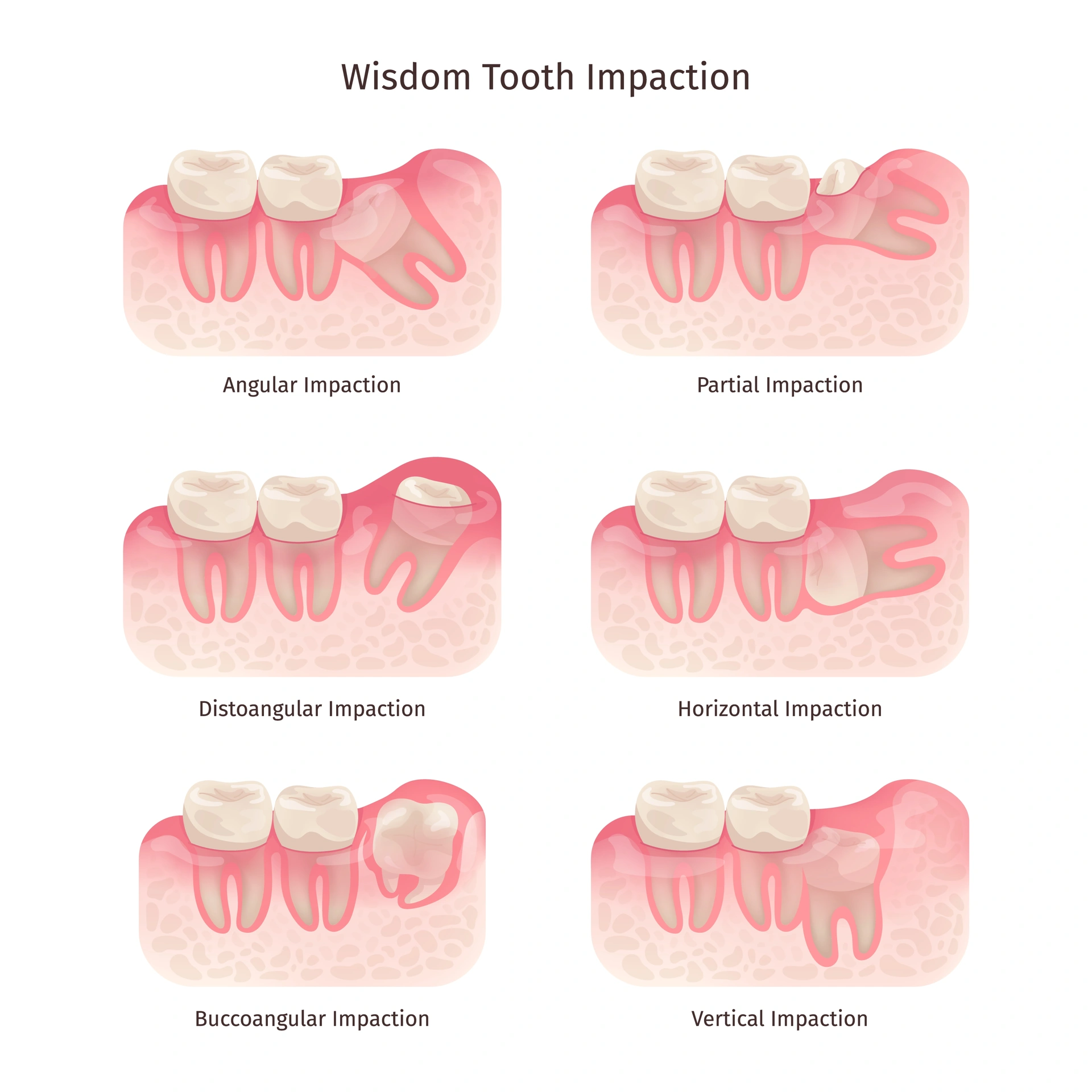 3D educational chart showing six types of wisdom tooth impaction: angular, partial, distoangular, horizontal, buccoangular, and vertical impaction. 