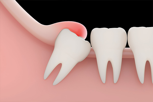 Do We Need To Remove Wisdom Teeth Affinity Dental Clinics