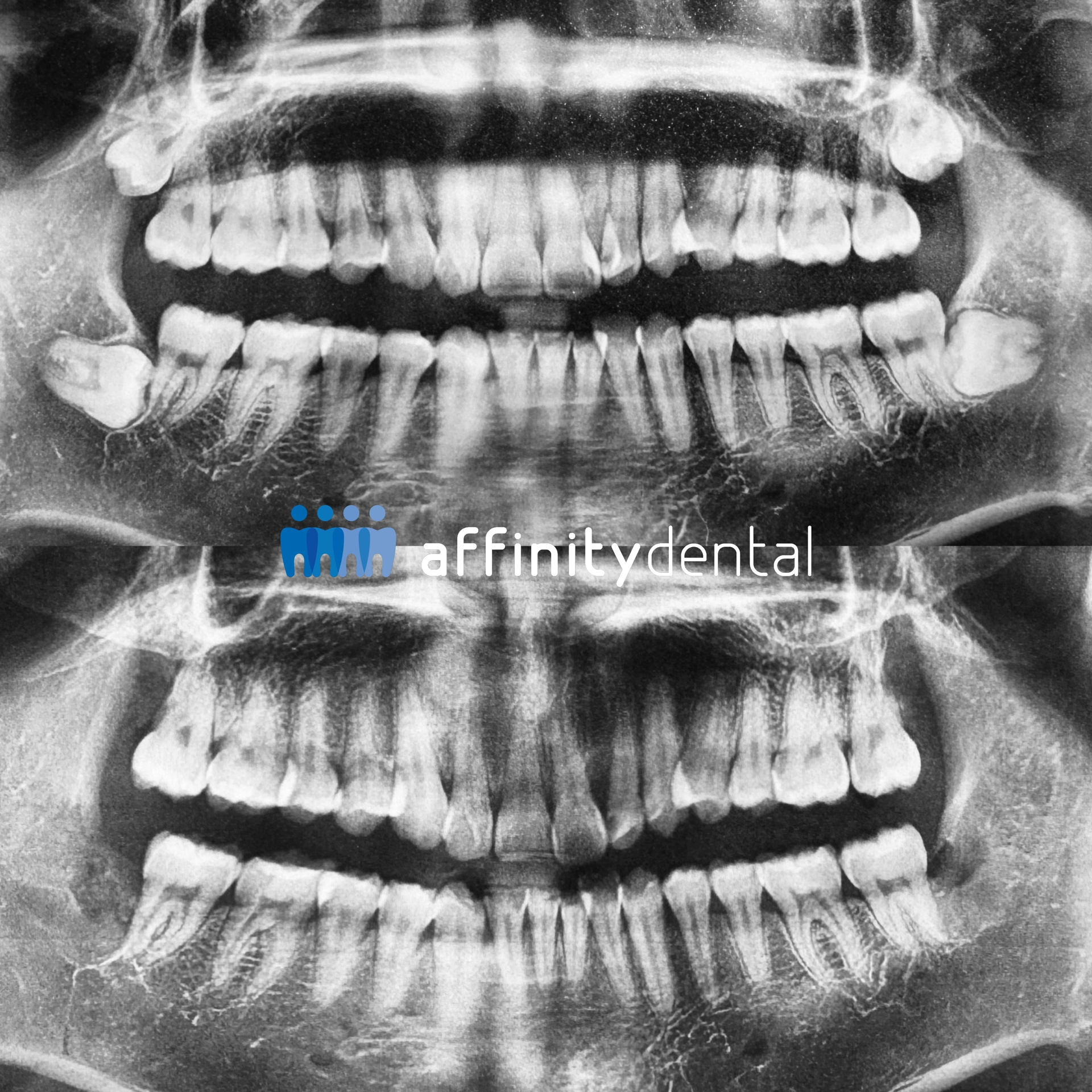 Panoramic dental X-ray showing removal of all four wisdom teeth by an oral surgeon at Affinity Dental Clinics Alabang