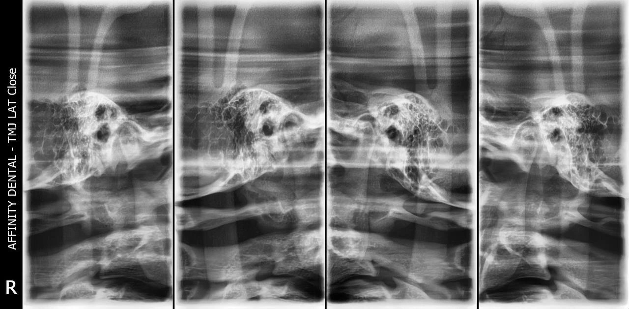Series of transcranial X-ray images showing the temporomandibular joints (TMJ) in open and closed positions for joint evaluation