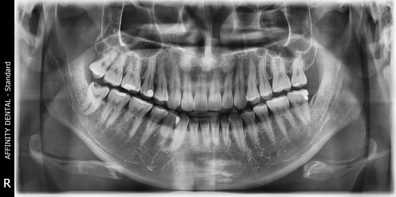 Panoramic dental X-ray showing full mouth view of teeth, jaw, and surrounding structures