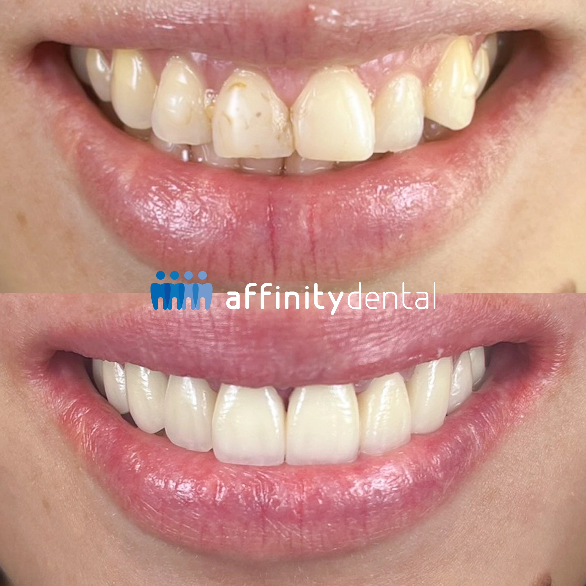 Before-and-after smile transformation with zirconia bridges and crowns at Affinity Dental Clinics Makati