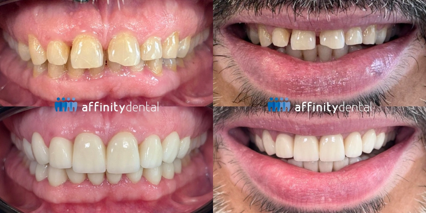 Before and after smile showing full mouth rehabilitation with zirconia crowns for a patient with severe tooth wear due to bruxism at Affinity Dental Clinics