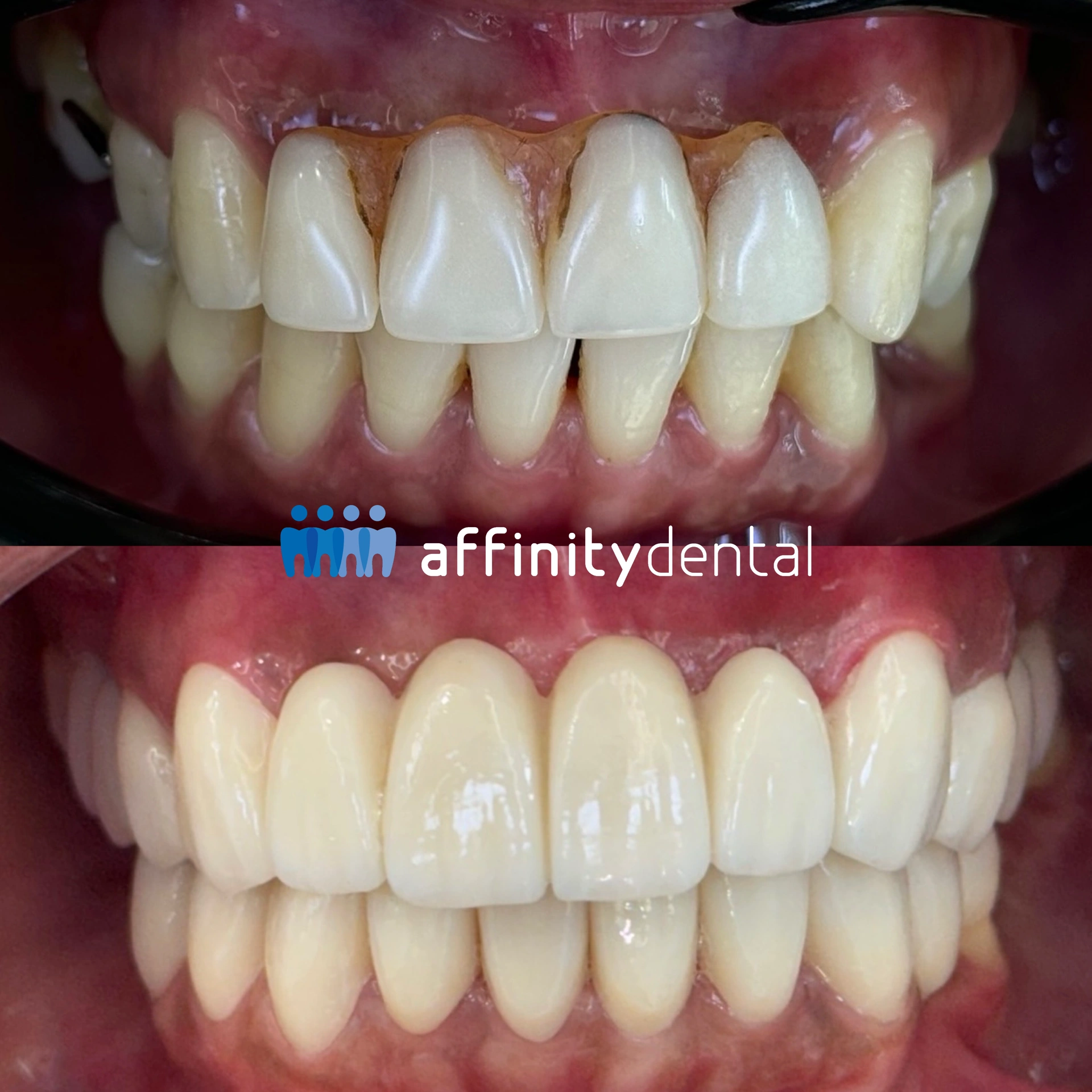 Before and after photo of a patient upgrading from removable denture to a fixed zirconia dental bridge at Affinity Dental Clinics, showing natural aesthetics and improved smile.