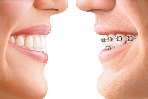 Braces vs Invisalign: What Should I Get?