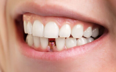 Dental Implant: Replacing Your Missing Tooth