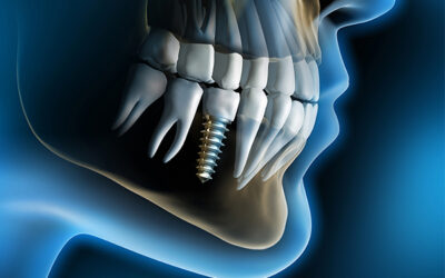 Dental Implants: A guide for your renewed smile