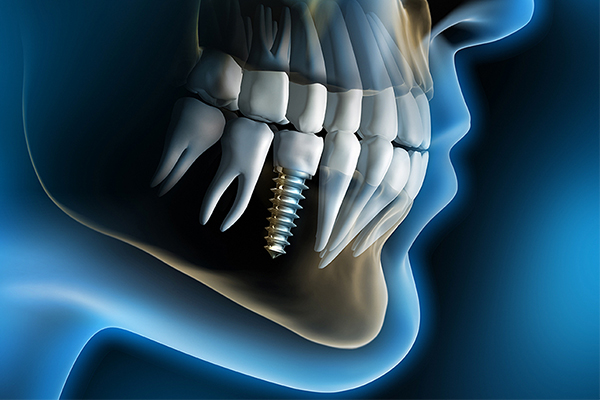 Dental Implants: A guide for your renewed smile