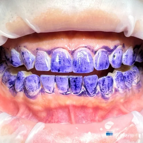 Close-up of teeth stained with purple disclosing solution to reveal biofilm and plaque buildup before guided biofilm therapy.