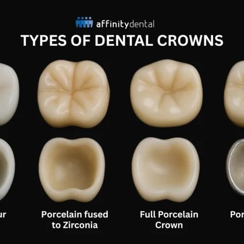 Image showing four types of dental crowns: Full Contour Zirconia, Porcelain Fused to Zirconia, Full Porcelain Crown, and Porcelain Fused to Metal—both occlusal and internal views.