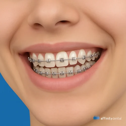 Close-up of a smiling patient wearing metal braces at Affinity Dental Clinics, highlighting orthodontic treatment based on malocclusion