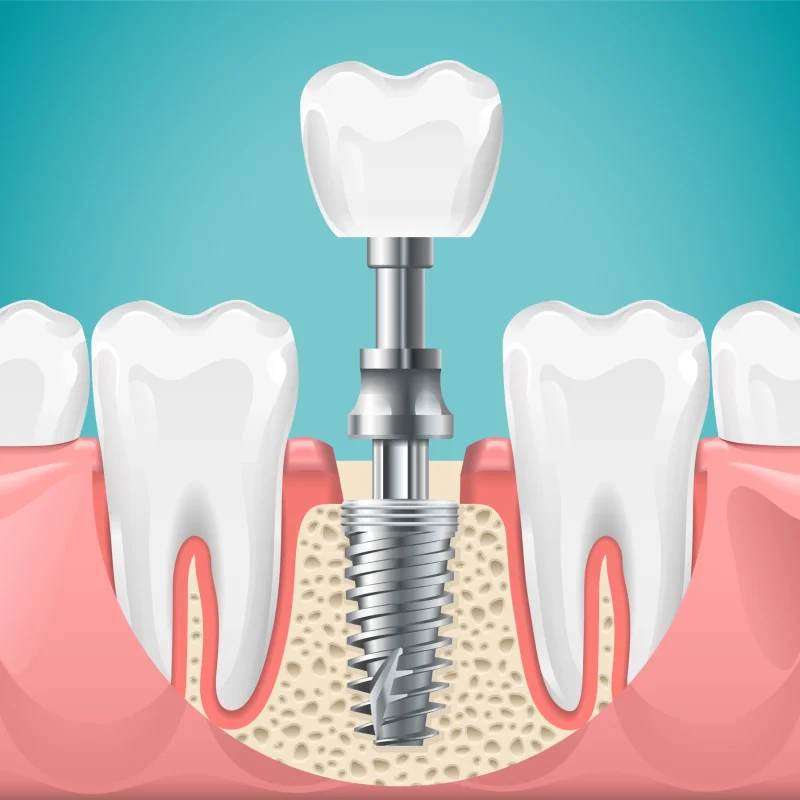 Dental implant procedure illustration showing titanium post, abutment, and crown for tooth replacement.