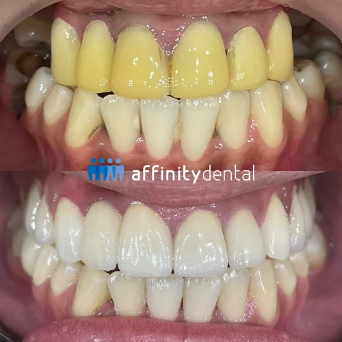 Replacing failed yellow dental crowns and bridge with zirconia – Affinity Dental Clinics Philippines before and after