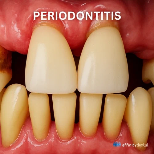 3D dental illustration of periodontitis showing gum recession, inflamed gums, and tartar buildup around the teeth.
