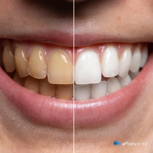 Before and after example showing yellow teeth compared to whiter teeth after teeth whitening treatment