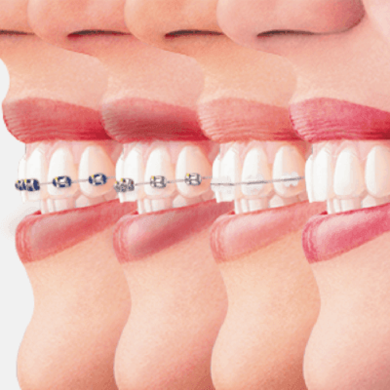 Types of Braces