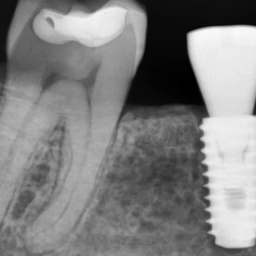 Periapical X-ray image showing a molar and adjacent dental implant in the lower jaw