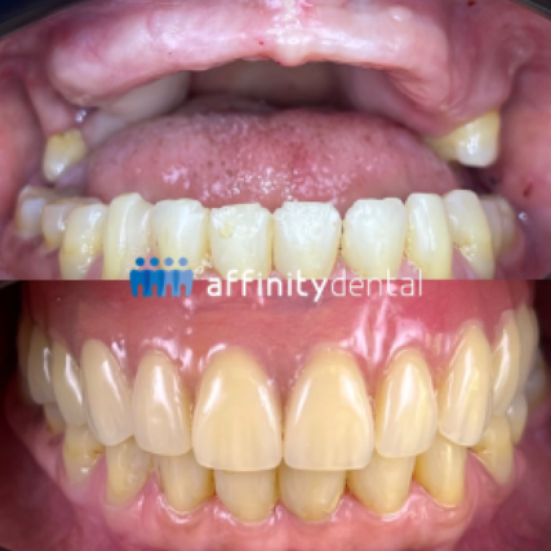 implant-supported-dentures-affinity-dental-clinics