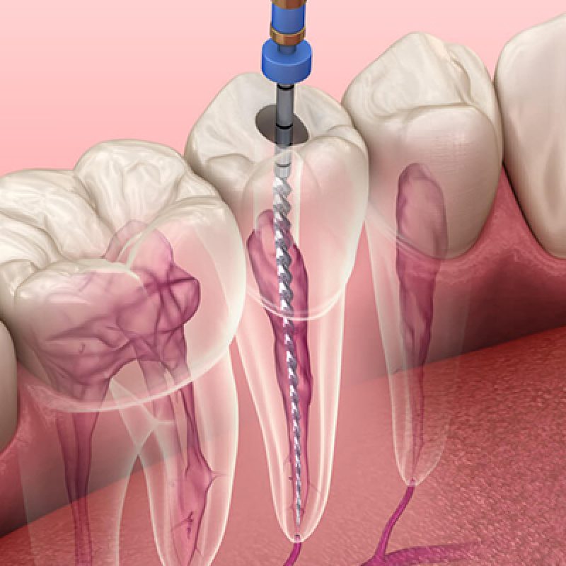 root canal