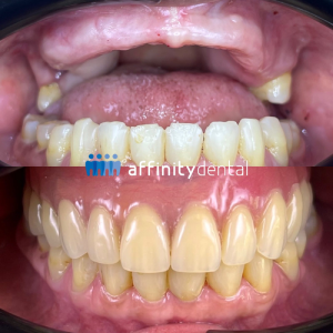 implant supported dentures