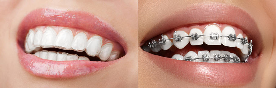 Slink zag opmerking Braces vs Invisalign: What Should I Get? | Affinity Dental Clinics