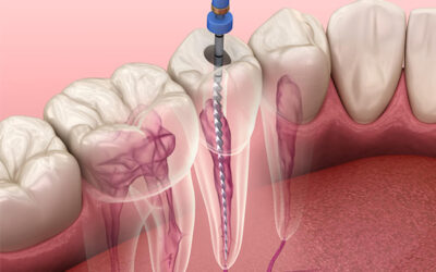How soon should I get a crown after root canal treatment?