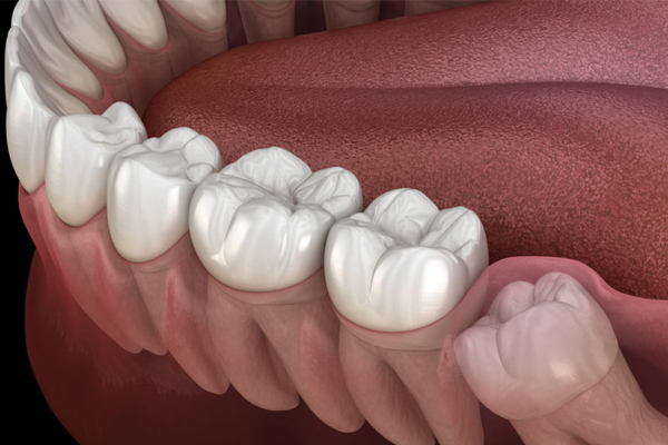 Wisdom Teeth and Oral Health