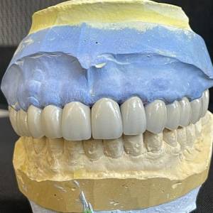 zirconia vs pfm