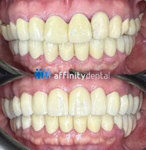 PFM vs. Zirconia Crowns and Bridges | Affinity Dental Clinics